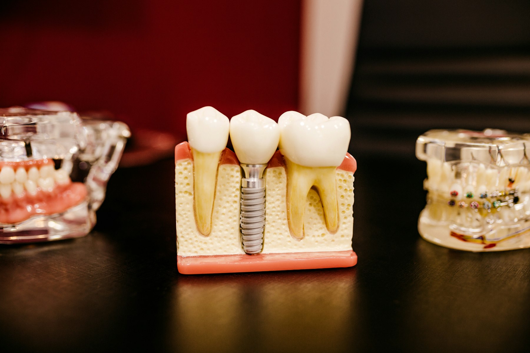 Model dentar cu implant și coroane